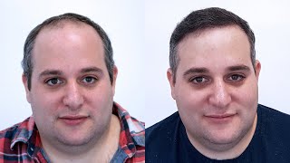 Dr Resul Yaman Hair Clinic - 4550 Grafts Result