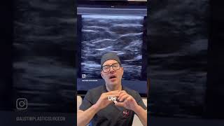 🍑✨ BBL Safety with Ultrasound Guidance