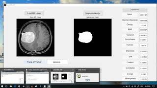 BRAIN TUMOR Detection using image processing in Matlab