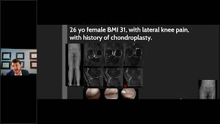 April 2020: Treatment of Cartilage Disorders and Early Knee OA