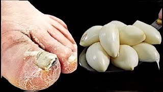 Cure toenail fungus. Best Recipe. Prepare in 1 minute! less than $1. You have to do it!