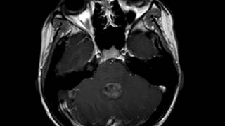 Ependymoma