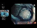 Case 14_Colonoscopy with chromoendoscopy and hybrid ESD technique for recurrent colonic adenoma