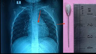 Bronchoscopic Foreign Body Removal of Hijab Pin - SQUARE HOSPITAL LTD Dhaka Bangladesh #BD_ENDOSCOPY