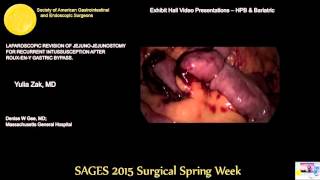 LAPAROSCOPIC REVISION OF JEJUNO JEJUNOSTOMY FOR RECURRENT INTUSSUSCEPTION AFTER ROUX ENY GASTRIC BYP