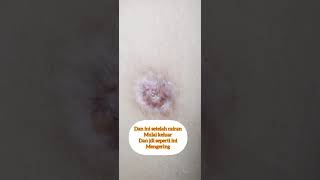 KELOID MENAHUN BISA RATA ?? 🤩 #keloid #humairaTv