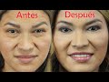 IMPRESIONANTE CAMBIO ❤️ Blefaroplastía y Lipoinjerto 👀 Ojos BONITOS 🤩 DR PERCY NEVADO