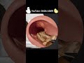 ASMR | Ear Cleaning and Earwax Removal