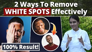 Effective Way | White Patches on SKIN ? | Use these 2 Methods #shlloka