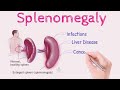 Splenomegaly OR Enlarged Spleen | Sign and Symptoms | Causes | Risk Factors | Treatment