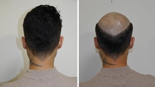 התהליך של שי | יחידת שיער | David Hair Solutions