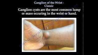 Ganglion cyst  Of The Wrist ,classic  - Everything You Need To Know - Dr. Nabil Ebraheim