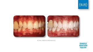 Kor Teeth Whitening