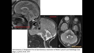 26. Blake's pouch cyst; posterior fossa, PMA, arachnoid cyst, mega cisterna magna, neuroimaging