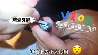 How to put temporary crown back in Place WITHOUT a dentist (how I did it during Covid-19 Lock Down)