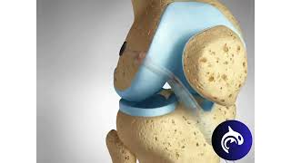 ACL PCL Surgical Reconstruction // See How It Works // 3D Animation