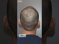 new hair transplant technology everyone is talking about