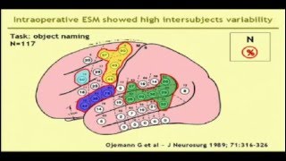 Dr Alberto Bizzi - Brain gliomas infiltrating the frontal lobe