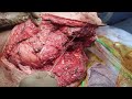 partial scapulectomy for secondary chondrosarcoma dr. nicola fabbri nyu langone orthopedics