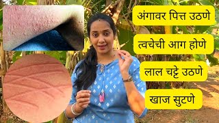 शीतपित्त चा माझा अनुभव आणि 100% खात्रीशीर आयुर्वेदिक उपाय 🌿 छपाकी 😥Urticaria | Hives skin allergy