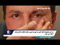 یک سال بعد از جراحی پلک پایین عمل جراحی پلک پایین کلینیک لیمون