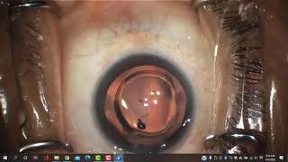 Excisional goniotomy with 23 gauge cystotome for glaucoma Daniel Laroche MD