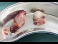 orchiectomy bilateral orchiectomy testis removal in prostate cancer