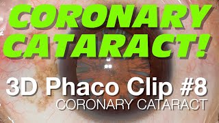 3D Phaco Clip #8 - Coronary Cataract (3DTV Version)