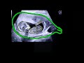 Ultrasound Revelation: Finding out the sex of the baby live - Pregnancy 13 weeks 1 day