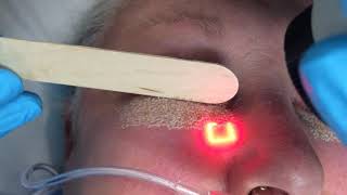 Laser Resurfacting - Active FX Laser