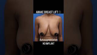 No implant autoaugmentation AWAKE BREAST LIFT®️ before and one day after.