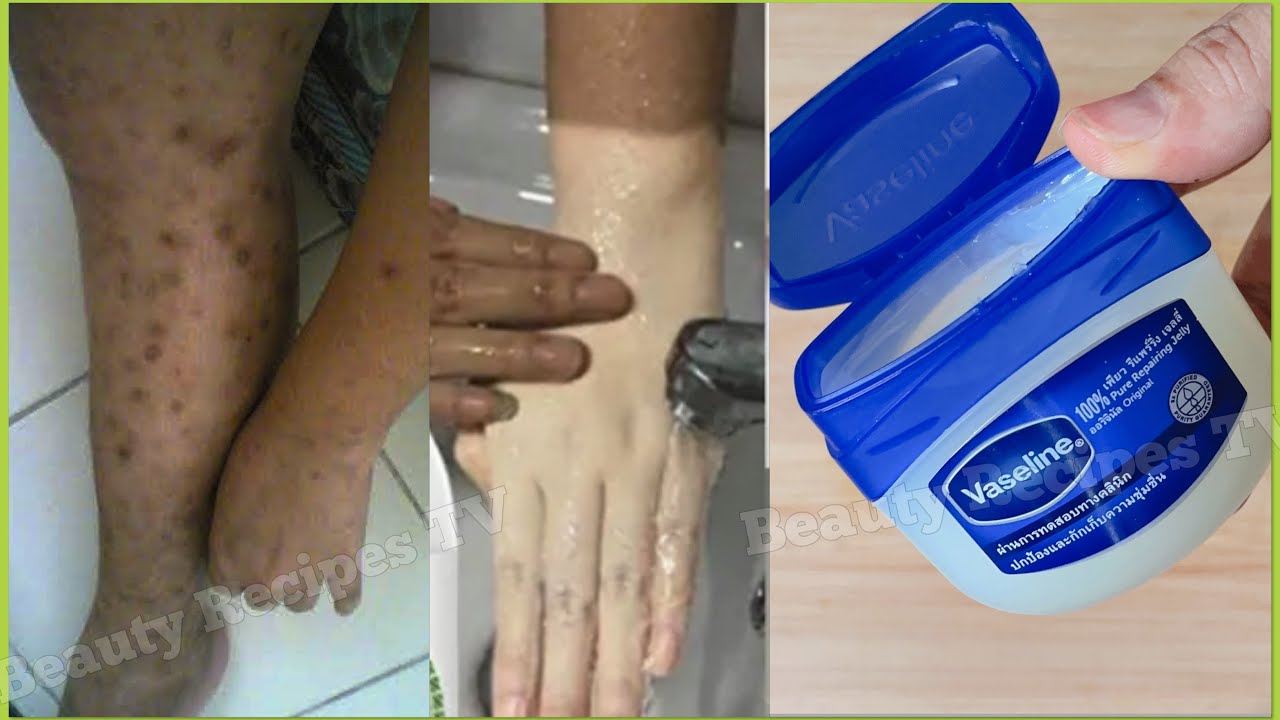 Only 3 Days! How To Get Rid Dark Spots On Legs With Vaseline,Mosquito ...