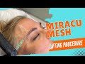 MIRACU MESH BROWS LOOKING LIFTED AND AWAKE IN MINUTES | Dr. Jason Emer