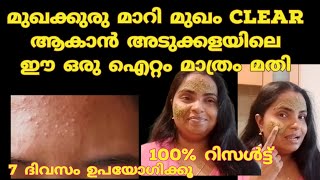 മുഖക്കുരു മാറാൻ അടുക്കളയിലെ ഈ ഒരു ഐറ്റം മാത്രം മതി | Mystyle with Jesna