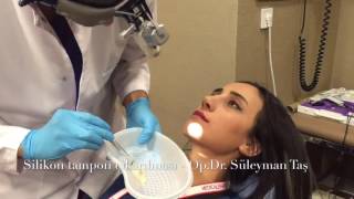 After Rhinoplasty - Volume 2: Removing Silicons