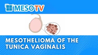 MesoTV | Mesothelioma of the tunica vaginalis (lining of the testes)