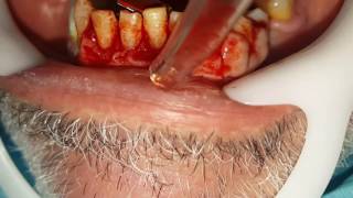 Treatment  of hyperplasia