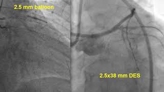 Megaly_Stent loss during LAD CTO PCI_Coronary