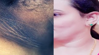 ಕಪ್ಪಾದ ಕುತ್ತಿಗೆ ಗೆ ಒಂದು ಸಿಂಪಲ್ ಮನೆಮದ್ದು / Natural Home Remedies For Dark Neck / Aadya Beauty Tips