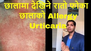 छालामा देखिने रातो फोका , छालामा देखिने Allergy Urticaria , by dr kalyan