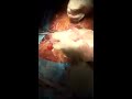 cesarean section