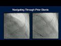 cvi 2019_thursday 7 18_ pci how to part 1 the basics_mitul patel md