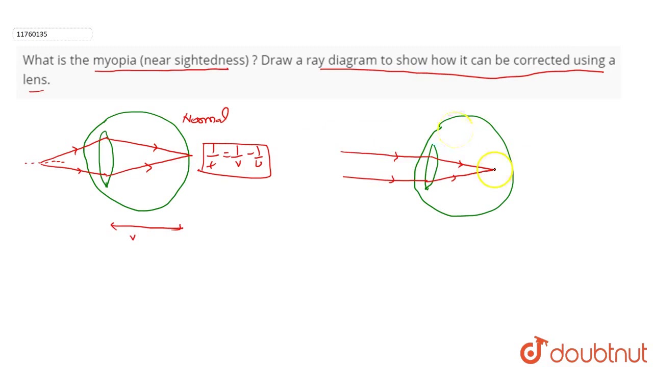 What Is The Myopia (near Sightedness) ? Draw A Ray Diagram To Show How ...