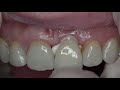 Cementation: Glass ionomer cements