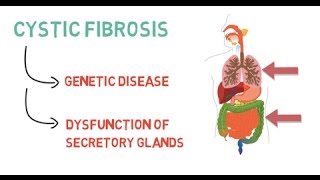 Cystic Fibrosis and Lung Transplants