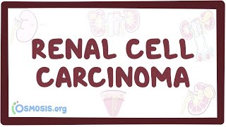 Renal cell carcinoma - an Osmosis Preview