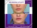 Revision Lip Lift