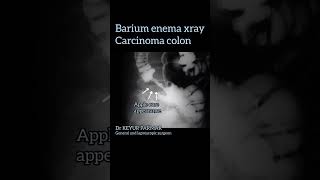 carcinoma colon appearance in barium enema | apple core appearance #shorts #ytshorts #ashortaday