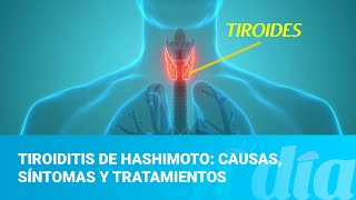 Tiroiditis de Hashimoto: causas, síntomas y tratamientos