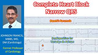 Complete Heart Block Narrow QRS